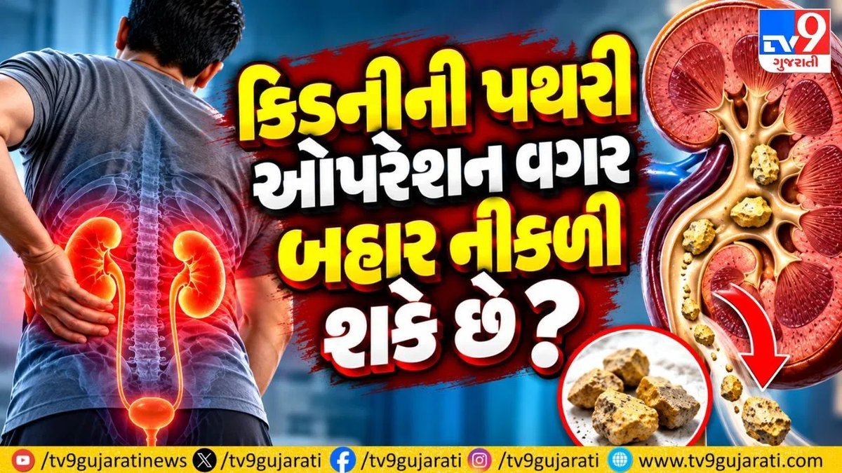 કિડનીની પથરી: 5 mm સુધીની પથરી ઓપરેશન વગર નીકળી શકે, 10 mmથી મોટીમાં સર્જરીની જરૂર